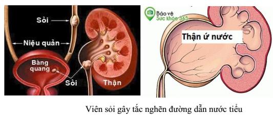 Lý thuyết Sinh học lớp 8 bài 40: Vệ sinh hệ bài tiết nước tiểu