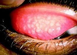 Lý thuyết Sinh học lớp 8 bài 50: Vệ sinh mắt