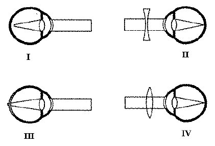 1.Nguyên nhân dẫn đến tật cận thị là: A. Cầu mắt quá dài so với bình thường.   	 B. Cầu mắt quá ngắn so với bình thường. 	 C. Cầu mắt quá mỏng.   	 D. Màng giác quá dày. 2. Biện pháp quan trọng để tránh các bệnh về mắt là: A. Rửa mắt thường xuyên bằng nước muối loãng và không dùng chung khăn mặt.   	 B. Rửa mắt thường xuyên bằng nước muối loãng. 	 C. Không dùng chung khăn mặt.    D. Đọc sách ở nơi có đủ ánh sáng, không đọc sách trên tàu xe. 3. Sơ đồ nào biểu thị ảnh của vật hiện lên trước màng lưới?  A. Sơ đồ IV.   	 B. Sơ đồ I. 	 C. Sơ đồ III.   	 D. Sơ đồ II. 4. Nhận định nào dưới đây về cách khắc phục các tật của mắt là đúng? A. Người cận thị phải đeo kính mặt lồi.   	 B. Người viễn thị phải đeo kính mặt lõm. 	 C. Người cận thị phải đeo kính mắt lõm, người viễn thị phải đeo kính mặt lồi.   D. Người viễn thị không phải đeo kính. 5. Bệnh đau mắt hột dễ lây lan do: A. Dùng chung khăn với người bệnh.   	 B. Dùng chung khăn, chậu với người bệnh hoặc tắm rửa trong ao hồ tù hãm.  C. Dùng chung chậu với người bệnh.   	 D. Tắm rửa trong ao hồ tù hãm. 6. Sơ đồ nào biểu thị ảnh của vật hiện lên sau màng lưới?  A. Sơ đồ III.   	 B. Sơ đồ IV. 	 C. Sơ đồ II.   	 D. Sơ đồ I. 7. Khi đi tàu xe không nên đọc sách vì: A. Khi đi tàu xe đông người không tập trung để đọc sách được.   	 B. Khoảng cách giữa sách và mắt luôn thay đổi nên mắt phải luôn điều tiết gây mỏi mắt, có hại cho mắt. 	 C. Khi đi tàu xe căng thẳng thần kinh nên đọc sách sẽ có hại cho mắt.   	 D. Khoảng cách giữa sách và mắt luôn thay đổi, sách bị rung. 8. Có thể phòng tránh được tật cận thị không? A. Có, nếu khi đẻ ra cầu mắt bình thường, khi đọc sách, báo...ta luôn đảm bảo đủ ánh sáng và giữ đúng khoảng cách.   	 B. Không, nếu khi đẻ ra, cầu mắt đã quá dài hoặc thủy tinh thể quá phồng. 	 C. Có, bằng cách đeo kính cận.   	 D. Có, nếu thay thủy tinh thể. 9. Viễn thị là gì? A. Là tật mà mắt chỉ có khả năng nhìn xa.   	 B. Là tật mà mắt chỉ có khả năng nhìn gần. 	 C. Là hiện tượng mắt có khả năng nhìn rõ ở bất kì khoảng cách nào.   	 D. Là tật mà mắt không có khả năng nhìn. 10. Nguyên nhân dẫn đến viễn thị là: A. Do thủy tinh thể bị lão hóa, mất khả năng điều tiết.   	 B. Cầu mắt ngắn bẩm sinh hoặc do thủy tinh thể bị lão hóa, mất khả năng điều tiết.. 	 C. Do thường xuyên nhìn quá xa.   	 D. Do thường xuyên đọc sách nơi thiếu ánh sáng. Đáp án kiểm tra 15 phút môn Sinh học lớp 8 bài: Vệ sinh mắt 