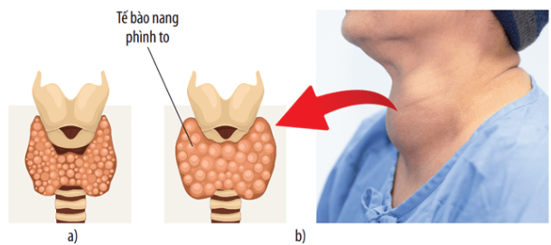 Tuyến giáp ở người bình thường (a) và người mắc bướu cổ do thiếu iodine (b)
