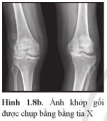 Giải Chuyên đề Vật lí 12 Cánh diều bài 1: Tia X và tạo ảnh bằng tia X